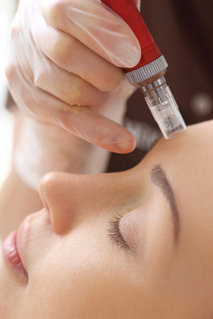 Everything You Need to Know About Microneedling